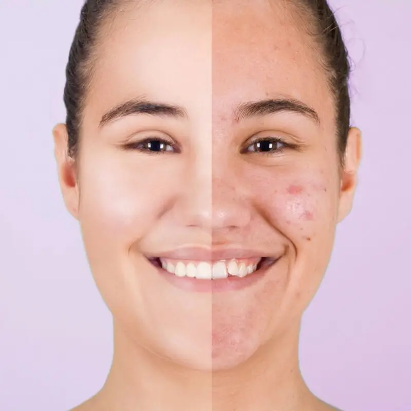 Acne/Blemishes